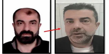 ankarada-filmleri-aratmayan-olay-yuzunu-degistirdi-ama-kaderini-degistiremedi-azmettirici-estetikle.webp